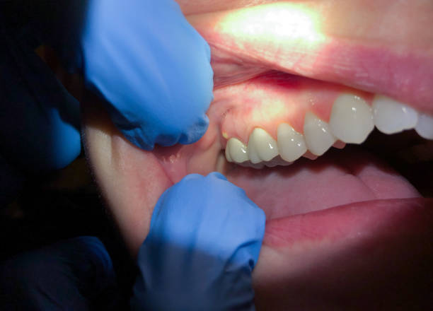 Emergency Dental Filling Replacement in VT
